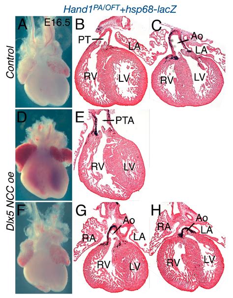 Mis-Expression of a Cranial Neural Crest Cell-Specific Gene Program in ...