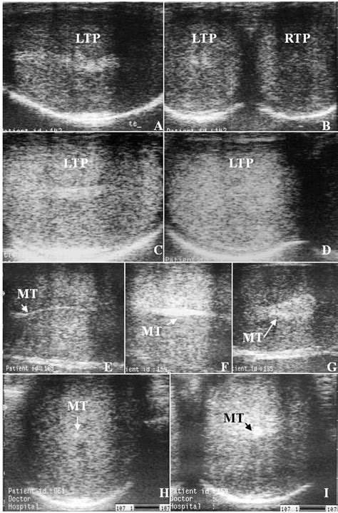Image result for Transillumination Test Testis