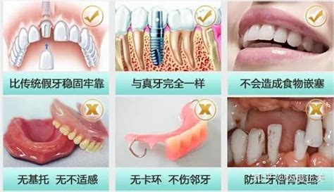 牙齿松动怎么办？这六种治疗方法你要知道 - 知乎