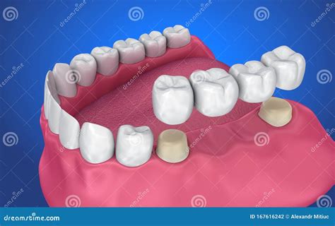 Tooth Supported Fixed Bridge. Medically Accurate Stock Illustration - Illustration of dentistry ...
