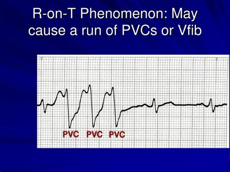 PPT - Arrhythmia and Devices in HF PowerPoint Presentation, free ...