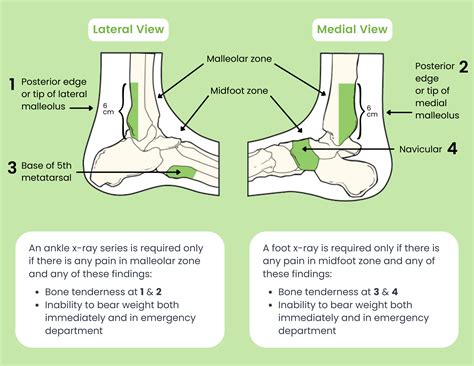 The Ottawa Ankle Rules — ChiroUp