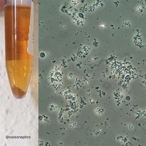 Amorphous Crystals In Urine Normal Range at Linda Landry blog