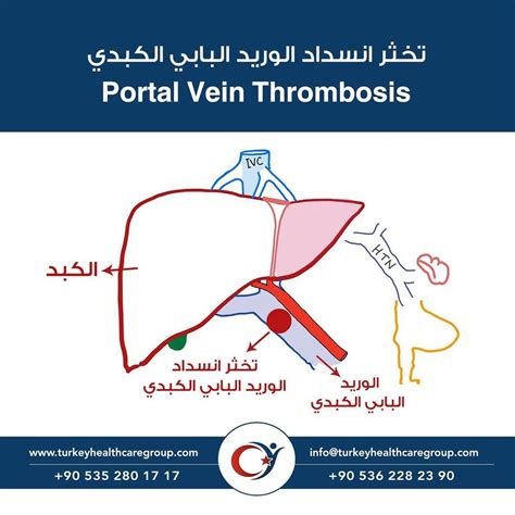 Portal Vein Thrombosis Symptoms Nontumoral Portal Vein Thrombosis: A