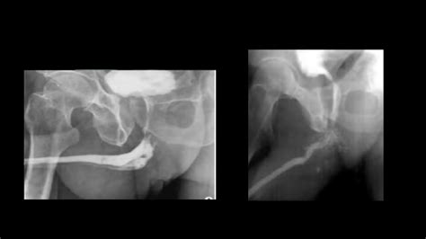 Image result for Retrograde Urethrogram RadioGraphics