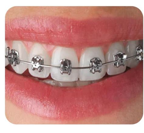 Orthodontic braces – Best dental clinic in Boduppal, Hyderabad