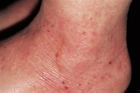 The Best Eczema Treatments for All Stages of Eczema