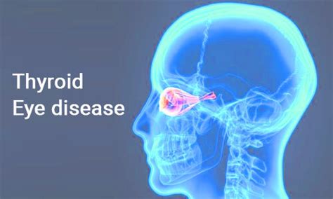 Teprotumumab improves symptoms and quality of life in thyroid eye ...