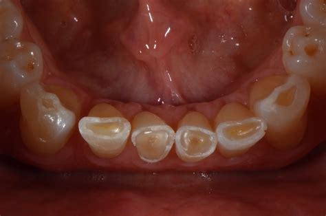 Image result for teeth grinding