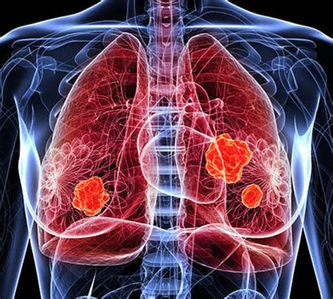 Image result for Diffuse Systemic Scleroderma