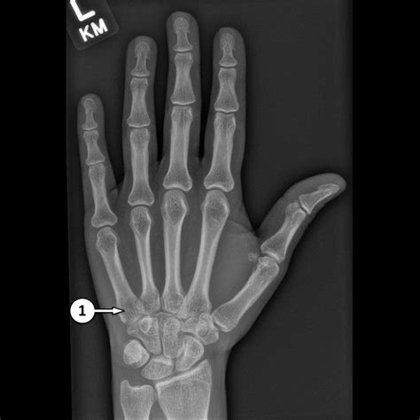 Top 93+ Pictures Normal X-ray Of Hand And Wrist Sharp