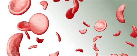 Sickle Cell Disease – TIF