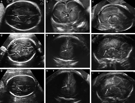 Non‐visualization of the cavum septi pellucidi is not synonymous with agenesis of the corpus ...