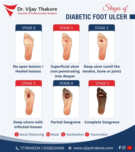 Types Of Foot Ulcers at Leo Hart blog