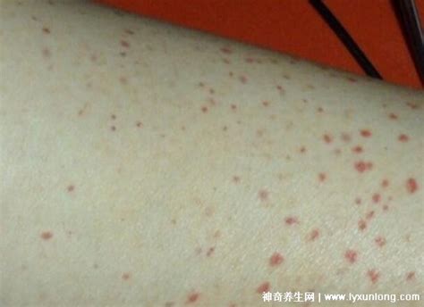艾滋病初期小红点照片，特征和斑丘疹/玫瑰丘疹相同(不痒不痛) | 藏斋网
