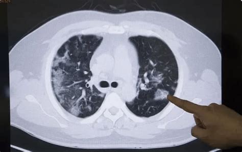 29岁姑娘确诊肺癌 确诊前系无症状感染-股城热点