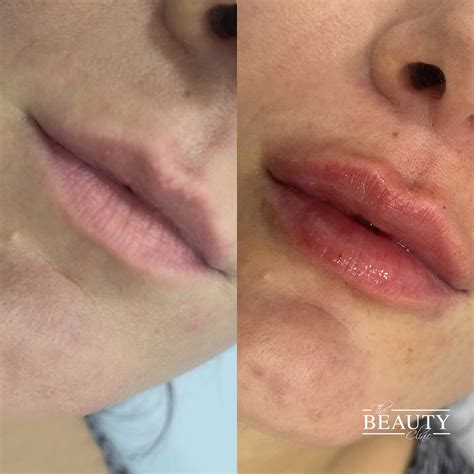 The Beauty Clinic | Top procedura hijaluronski fileri usne, brada i ...