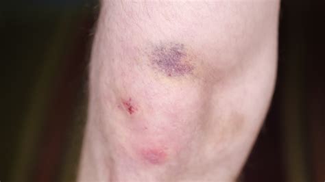 Knees bruised after a fall 48655061 Stock Video at Vecteezy