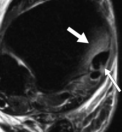 Bone Marrow Edema Patterns in the Ankle and Hindfoot: Distinguishing ...