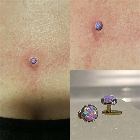 How To Treat Navel Piercing Keloid at Wilson Orr blog