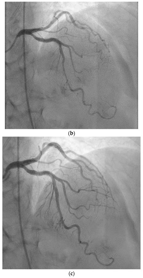 Rare Clinical Manifestation of Vasculitis