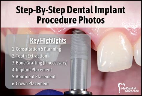 Tooth Implants Procedure 的图像结果