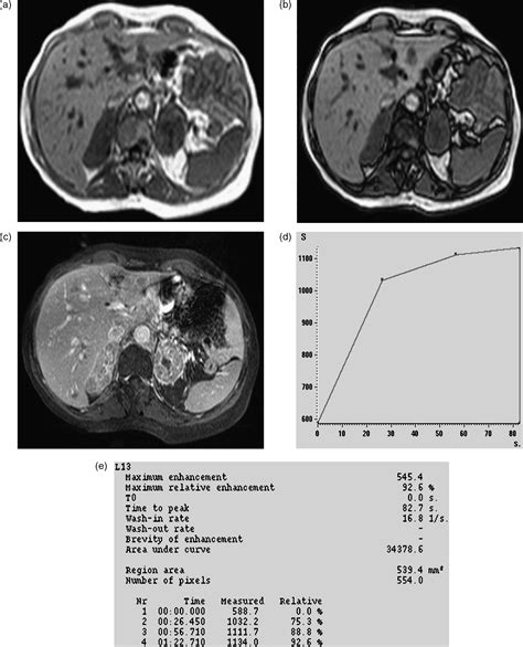 Dynamic contrast enhanced MRI in the differential diagnosis of adrenal ...