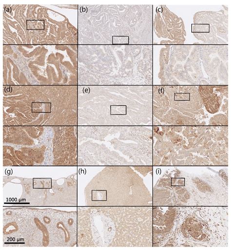 AKR1B1 and AKR1B10 as Prognostic Biomarkers of Endometrioid Endometrial ...