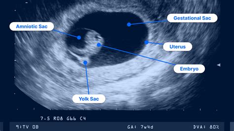 How to Read an Ultrasound: Colors, Numbers and Abbreviations