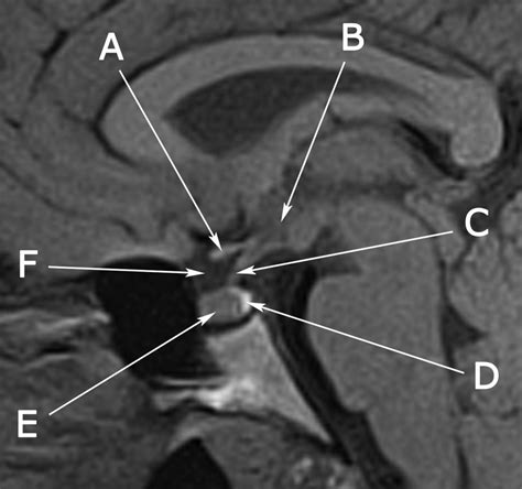 Pituitary Gland Anatomy Mri