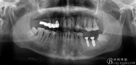 标准牙齿x光片,标准牙齿侧面光片,牙齿侧面光片_大山谷图库