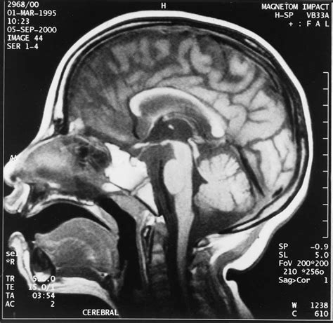 Image result for Diffuse Atrophy