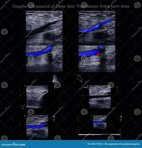 Color Doppler Ultrasound Determination in Deep Vein Thrombosis Patients for Finding Deep Vein ...