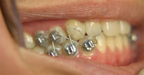Jaw Wiring To Lose Weight