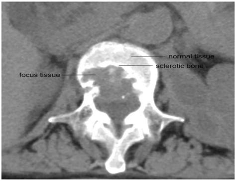 The Distribution Pattern of First-Line Anti-Tuberculosis Drug ...