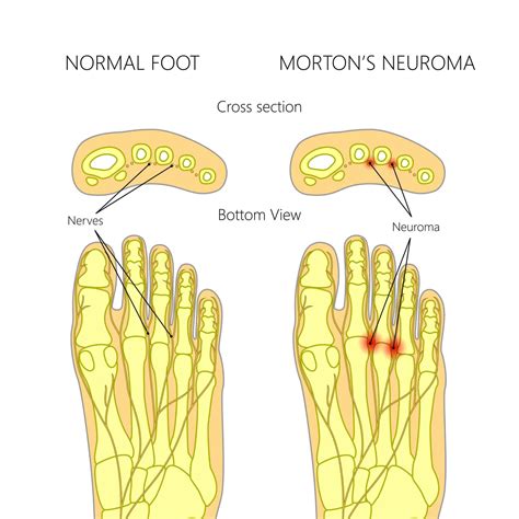 Morton's Neuroma Surgery