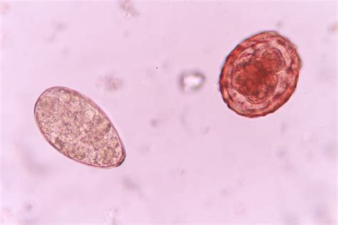 Parasites and cancer | CANCERactive