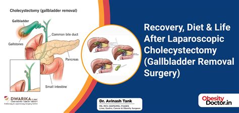 Recovery, Diet & Life After Laparoscopic Cholecystectomy (Gallbladder Removal Surgery) - Dr ...