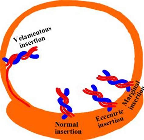 Velamentous cord insertion causes, risks, diagnosis & delivery