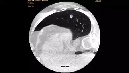 Philips - XperGuide ablation