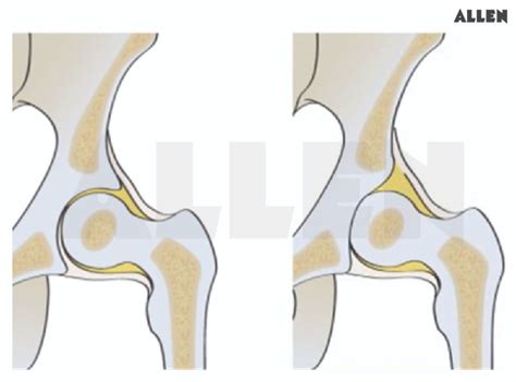 Acetabulum: Function, Types and FAQs