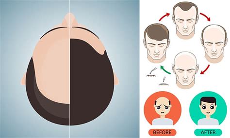 Best Hair Loss Treatment in Hyderabad | Trichos Hair Transplant