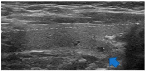 Introducing a Pole Concept for Nodule Growth in the Thyroid Gland ...