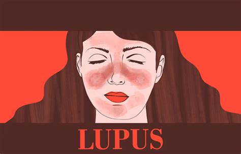 Active systemic lupus erythematosus patients more susceptible to ...