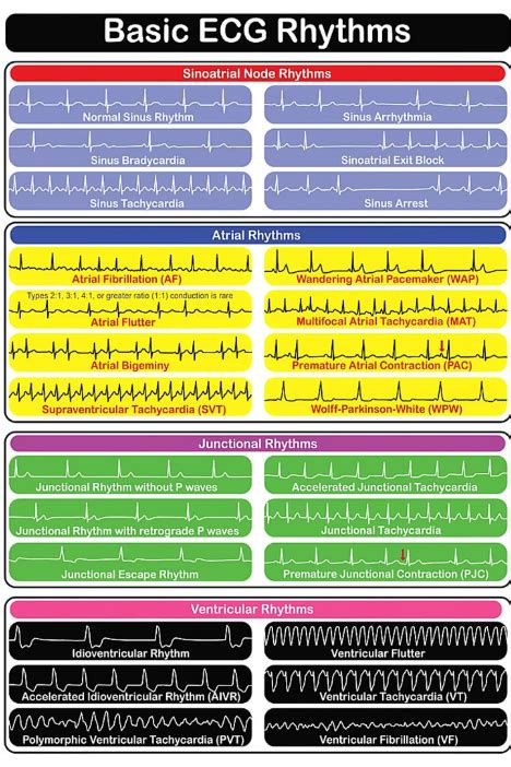 Basic ECG Rhythms 的图像结果