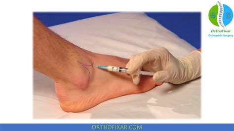 Image result for Ankle Injection Procedure