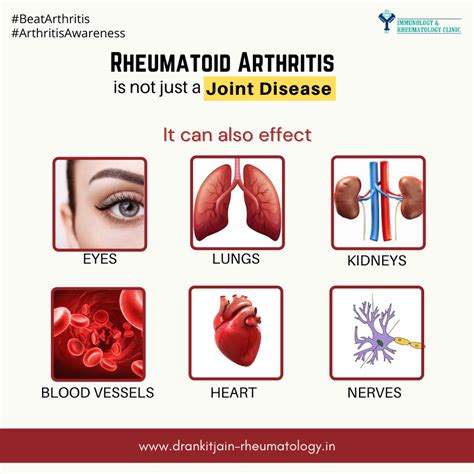 Best Rheumatologist in Meerut | Dr Ankit Jain Meerut