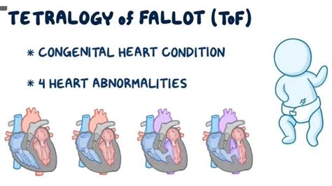 Patent Tetralogy of Fallot diagnosis and latest care options