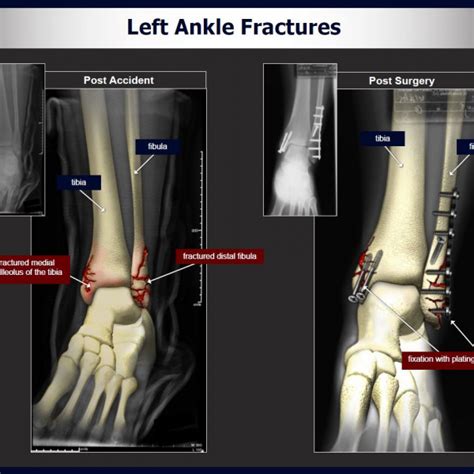Left Ankle Fractures - TrialExhibits Inc.