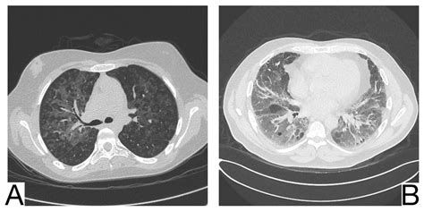 Challenges in the Differential Diagnosis of COVID-19 Pneumonia: A ...
